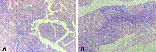A. Patolog�a quir�rgica Caso 3. (A). Papilas revestidas por epitelio con abundante citoplasma eosinof�lico granular (oncoc�tico). Exhiben un eje central expandido por abundante infiltrado inflamatorio linfoplasmocitario. Tinci�n H-E, 10x. (B). Tiroiditis de Hashimoto. Fol�culos tiroideos con cambios oncoc�ticos rodeados por abundante infiltrado inflamatorio linfoplasmocitario con formaci�n de fol�culos linfoides. Tinci�n H- E, 10x.