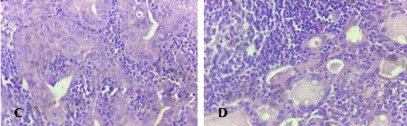 (C). Aspecto nuclear de carcinoma papilar: aclaramiento nuclear, barras cromat�nicas y nucl�olos. Tinci�n H-E, 40x. (D). Cambios oncoc�ticos de las c�lulas foliculares. Tinci�n H-E, 40x.