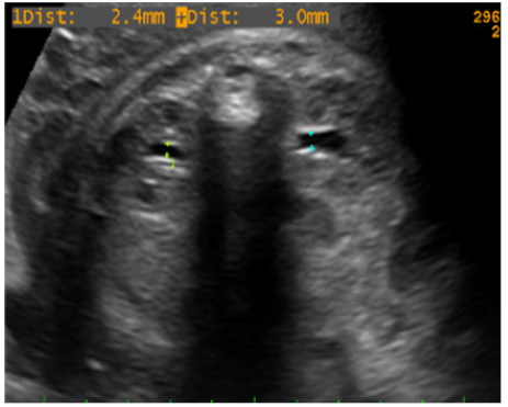 Imagen ultrasonográfíca del abdomen fetal bajo en corte transversal
donde se puede visualizar ambos riñones a cada lado de la columna vertebral y
la medición de ambas pelvis renales. Ilustración tomada de los protocolos de
medicina fetal del Hospital Clínic Barcelona. 

 