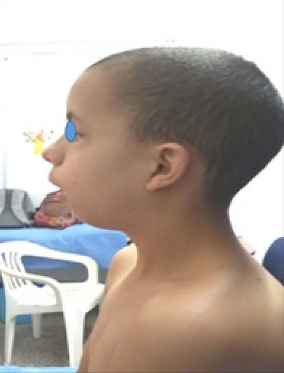 Obsérvese implantación baja de los pabellones auriculares y micrognatia.