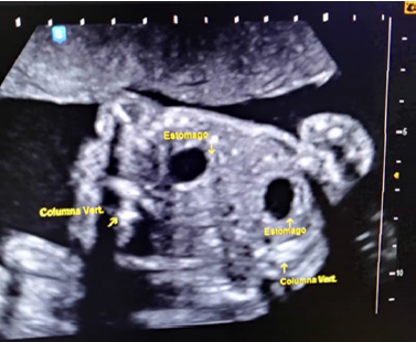 Corte axial de abdomen fetales fusionados: se observa 2 estomagos y 2 columnas vertebrales (ver flechas).