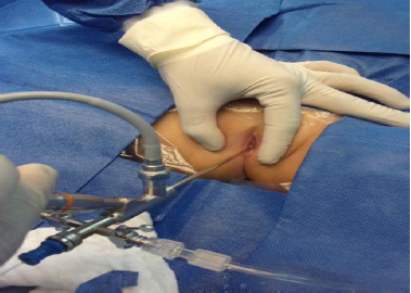 Vaginoscopia en ni�a con sangrado vaginal.