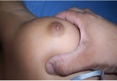 Himen congestivo edematoso por estrogenizacion.