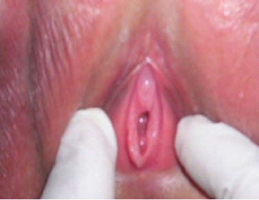 Hiperpigmentacion del complejo areola /pez�n.