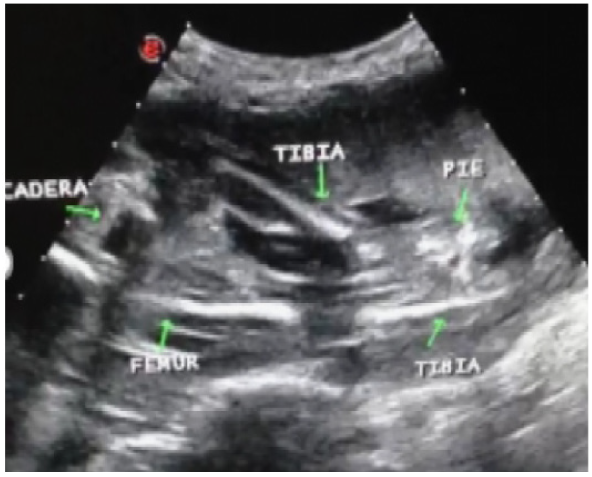 Ultrasonograf�a: Asimetr�a en extremidades inferiores por ausencia de femur izquierdo. Tibia y Peron� izquierdos visualizables al mismo nivel de femur derecho donde deber�a estar el femur izquierdo ausente