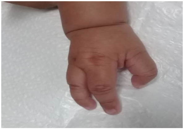 Ectrodactilia en mano derecha