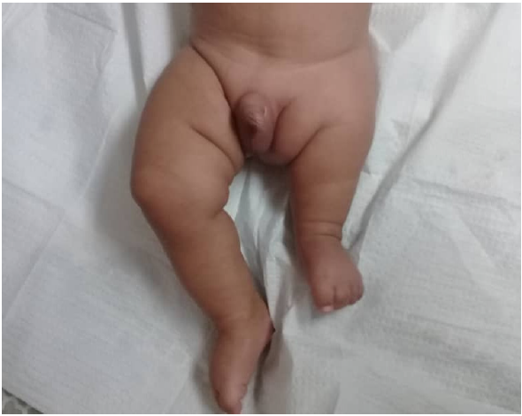 Extremidades asim�tricas: Acortamiento de miembro inferior izquierdo