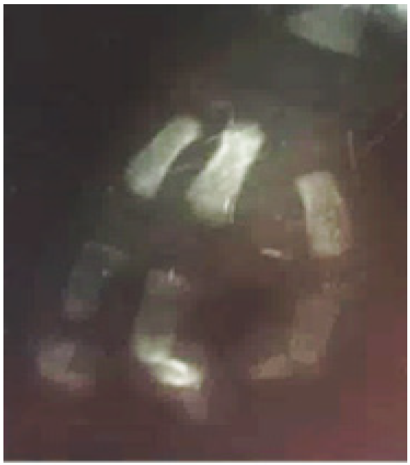 Correlaci�n radiol�gica de ectrodactilia en mano derecha