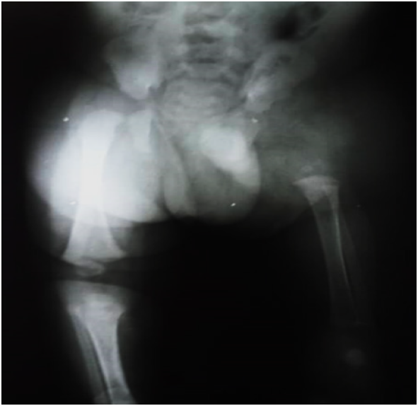 Correlaci�n radiol�gica de extremidades inferiores apreciando femur izquierdo ausente con tibia y peron� izquierdos al mismo nivel de femur derecho