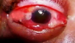 Edema palpebral, quemosis, cámara anterior estrecha.