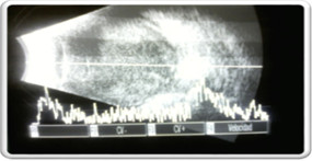 Opacidades vítreas y desprendimiento de retina seroso.