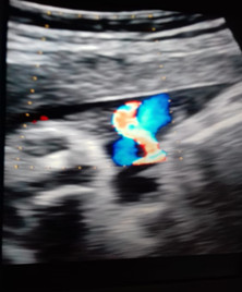 Imagen de la AUU por ultrasonido doppler.
