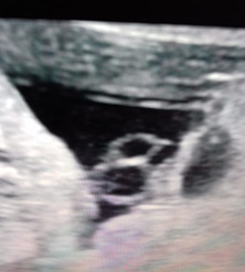 Imagen de la AUU por ultrasonido abdominal.