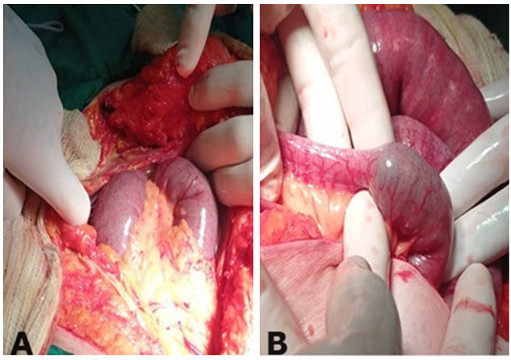 Distensi�n y edema de asas delgadas (A); c�lculo biliar de gran tama�o en el interior del ilion proximal (B).