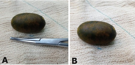 C�lculo biliar de gran tama�o en comparaci�n a pinza de Kocher (A); c�lculo biliar de gran tama�o (B).