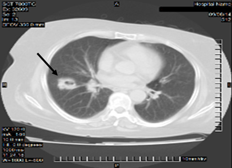 Nódulo pulmonar derecho cavitado.