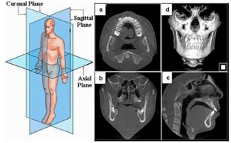 (Izq.) Esquema de los diferentes planos que forman los llamados cortes tomográficos y (dcha.) ejemplo de imágenes TC de la zona maxilofacial de un paciente: (a) axial, (b) coronal, (c) sagital y (d) reconstrucción tridimensional a partir de numerosos cortes. (Claudia, 2012)