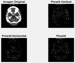 La imagen original (superior izquierda), detectando bordes verticales (superior derecha), detectando bordes horizontales (inferior izquierda) y bordes totales (inferior derecha).