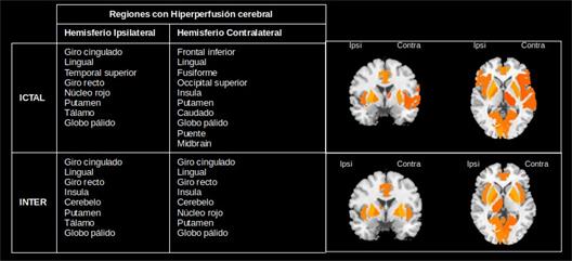Patrones de hiperperfusión en el estado ictal e interictal de pacientes con epilepsia del lóbulo temporal.