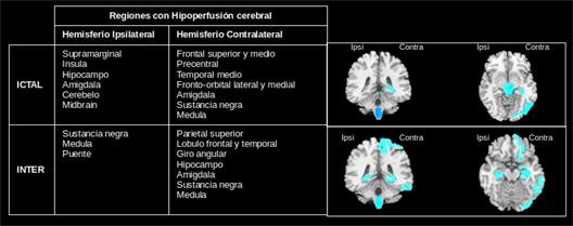 Patrones de hipoperfusión en el estado ictal e interictal de pacientes con epilepsia del lóbulo temporal.