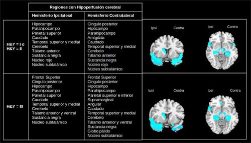 Patrones de hipoperfusión de ambos hemisferios en el estado inicial y avanzado de la EP.