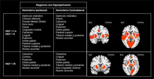 Patrones de hiperperfusión de ambos hemisferios en el estado inicial y avanzado de la EP.