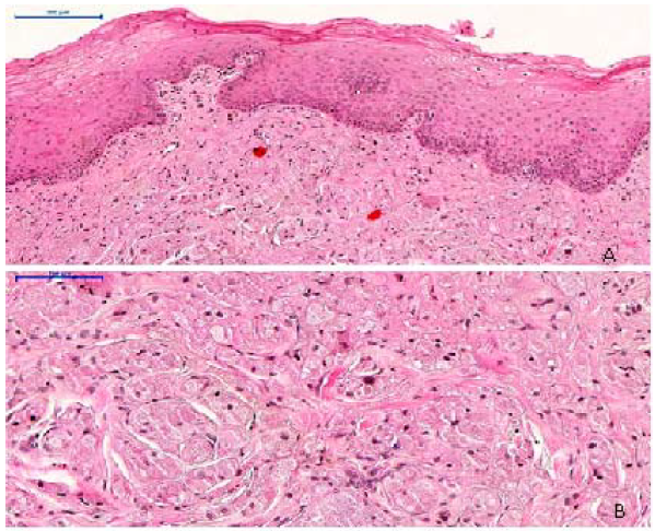 Aspecto histopatológico evidenciando epitélio pavimentoso estratificado paraceratinizado (A) adjacente a o tecido conjuntivo apresentando uma proliferação de células arranjadas em ilhas e com citoplasma granular (B), HE.