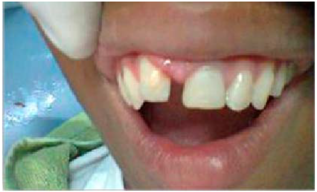 Obs&eacute;rvese la preservaci&oacute;n de los tejidos periodontales.