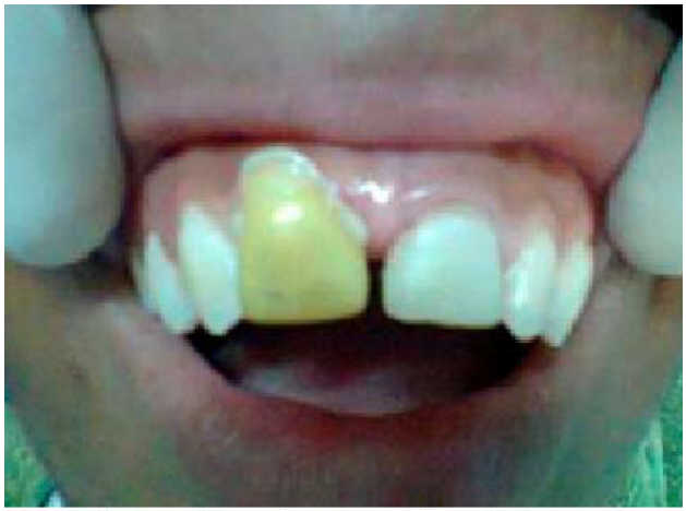 Conformaci&oacute;n y ajuste de preforma pl&aacute;stica.