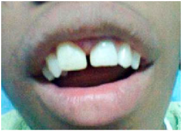 Tallado y pulido final de la superficie.