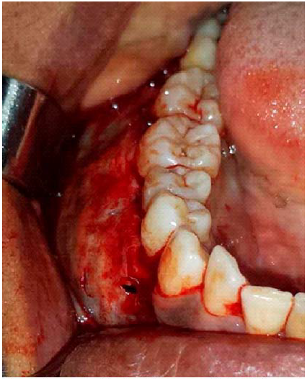 Visita transquir&uacute;rgica del hueso mandibular. Obs&eacute;rvese la presencia de expansi&oacute;n cortical con perforaci&oacute;n en algunos sitios.