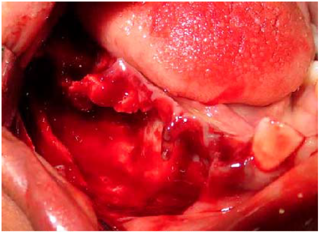 Vista transquir&uacute;rgica. N&oacute;tese la presencia de tabiques &oacute;seos y cavidades con sangre entre las ra&iacute;ces de los clientes involucrados.
