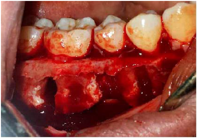Vista transquir&uacute;rgica donde se aprecia la cavidad resultante de la zona afectada.