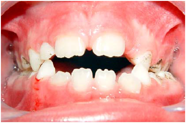 Manchas negras extrínsecas na região cervical e terço médio em criança de 5 anos de idade em fase de dentição mista.