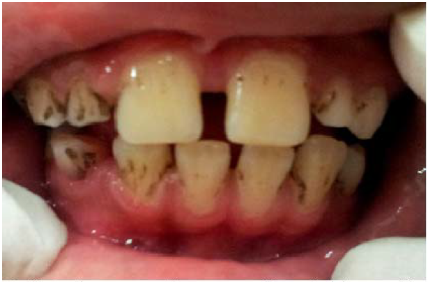 Manchas negras extrínsecas na região cervical das superfícies lisas dos dentes decíduos e permanentes em criança portadora de Diabetes Mellitus tipo I de 12 anos de idade.