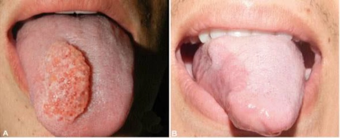 Aspecto clínico pré e pós-operatório: A) Lesao base séssil e textura "pedragosa" compatível com múltiplos espacos linfaticos hermatomatosos. B) Aspecto clínico após 1 ano do tratamiento cirúurgico, evidenciando a preservacao do órgao.