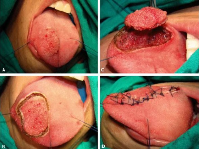 Excisao cirúrgica dalesao: A) Estabilizacao da língua com fios de algodao B) Delimitacao das margens. C) Elevacao da lesao e excisao da mesma com eletrocautério. D) Fechamento primário do sitio cirúrgico. 