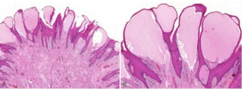 Fotomicrogafias: A) Amplos espacos vasculares linfáticos localizados principalmente na regiao subepitelial, os quais sustituem o tecido conjutivo interpapilar. Note a superficie papilar da lesao. B) Maior aumento mostrando os delhes dos vasos linfaticos superficiales