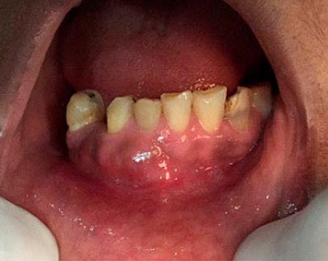 Se observa inflamaci&oacute;n y p&eacute;rdida de contorno gingival a nivel de &oacute;rganos dentarios anteroinferiores derechos como resultado de exacerbaci&oacute;n.