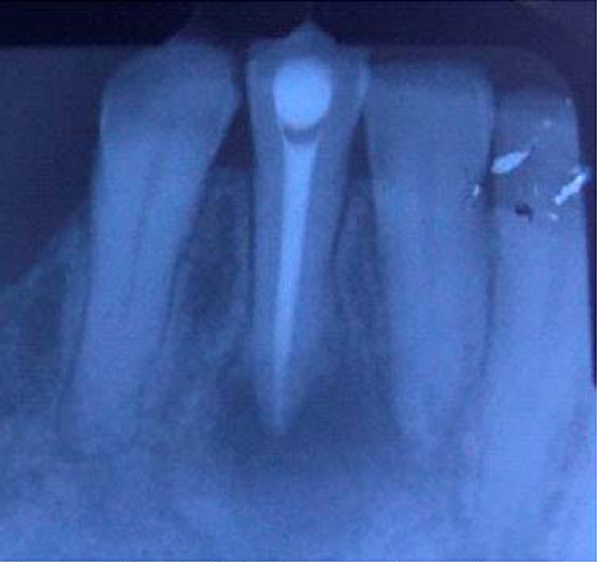 Radiograf&iacute;a final en la que se observa la creaci&oacute;n de tope aplica con MTA y obturaci&oacute;n de gutapercha.