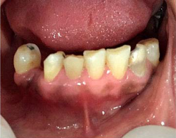 Disminuci&oacute;n de inflamaci&oacute;n cl&iacute;nica 15 d&iacute;as despu&eacute;s.