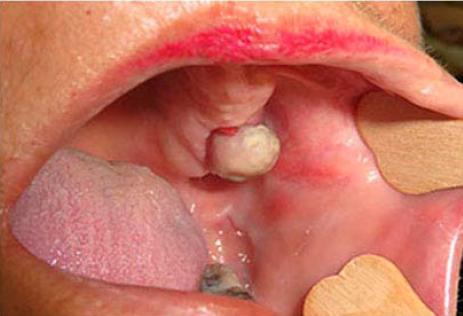 Aspecto bucal de la lesi&oacute;n maxilar