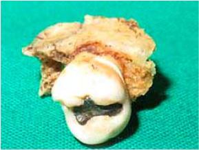 Combinaci&oacute;n de molar con fragmento &oacute;seo adherido que corroba diagn&oacute;stico de fractura de la tuberosidad