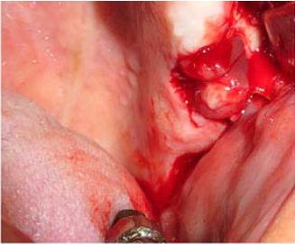 Aspecto de los p&oacute;lipos sinusales herniados del seno maxilar luego del abordaje bucal. N&oacute;tese que la parte vestibular de los p&oacute;lipos que se encontraba cubierta de mucosa muestra una apariencia m&aacute;s transparente.