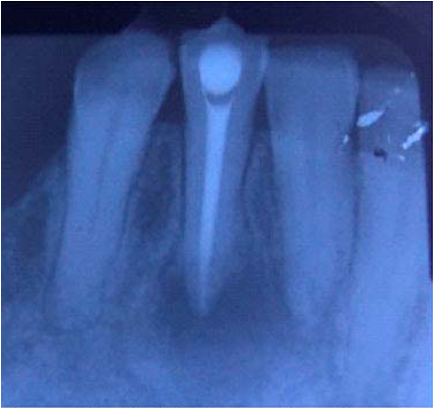 Radiograf&iacute;a final en la que se observa la creaci&oacute;n de tope apical con MTA y obturaci&oacute;n con gutapercha.
