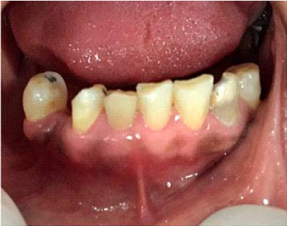 Disminuci&oacute;n de inflamaci&oacute;n cl&iacute;nica 15 d&iacute;as despu&eacute;s.