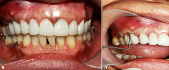A fistula in the attached gingiva of dental organ 14 and reddened gum is observed in the right image. In the left image, a 6mm probing depth is observed.