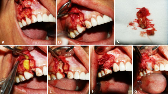 In the left image, the vestibular root of dental organ 14 can be clearly observed after performing the mucoperiosteal flap. In the central image the post-extraction alveolus is observed and in the image on the right, the extracted premolar is observed. In the image on the left, a cotton wool embedded in diluted tetracycline is used to perform the bio modification of the alveolus. In the following image the clean alveolus is observed after the bio modification. In the following image the bovine bone graft is observed and in the image on the right, the placement of the FRP membrane on the bone graft is observed.