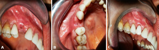The gingiva is observed without signs of inflammation 4 months after the procedure and the placement of a fixed partial denture type cantilever in the zone of dental organs 14-15.
