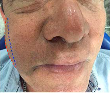 Obs�rvese la discontinuidad del contorno facial asociada con el sobrepaso de hoploclorito de sodio a tejidos perirradiculares